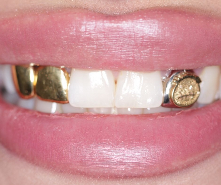 Grillz: Cool, aber nicht ohne Risiko!